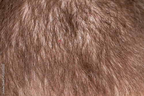 Hair loss adult man on a back of head. Irritated scalp skin.