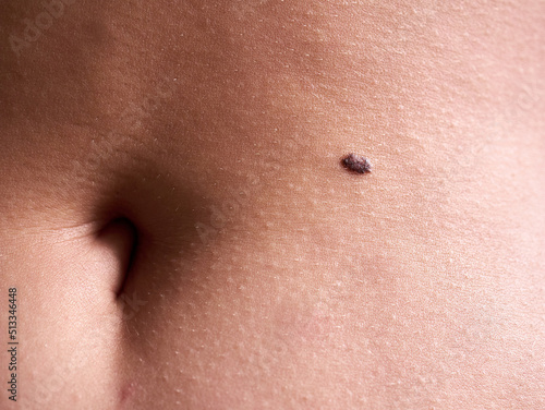 Canvas Print Mole close to the belly button