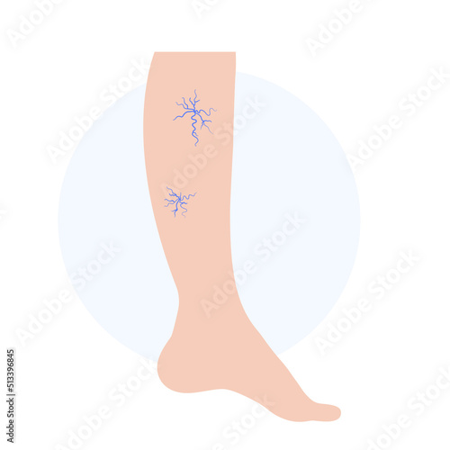 Spider veins treatment