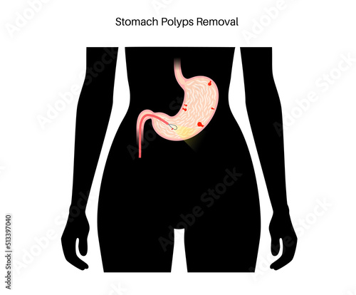 Stomach polyp removal