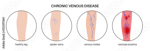 Varicose veins treatment