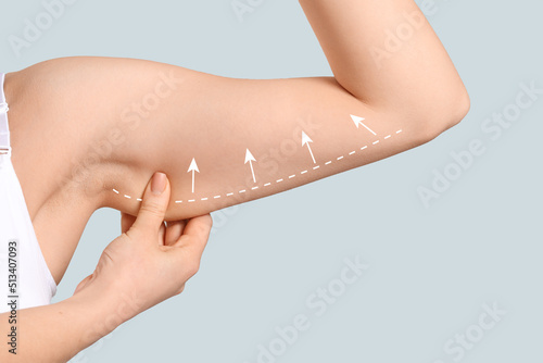 Arm of young woman after slimming on light background. Plastic surgery concept photo