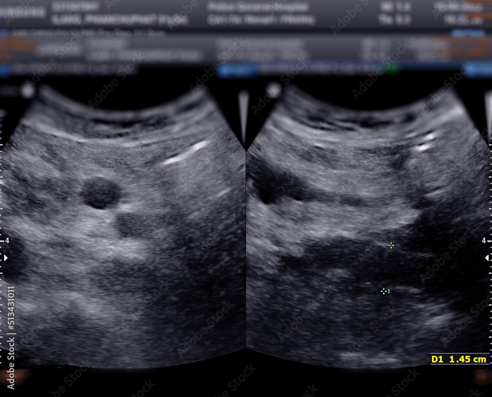 Ultrasound of urinary bladder or KUB for screening renal and bladder
