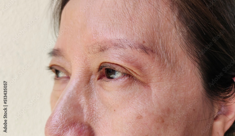 close up portrait showing the flabbiness and wrinkle beside the eyelid, problem blemish on the face of the woman, concept health care. close up portrait showing the flabbiness and wrinkle beside the eyelid, problem blemish on the face of the woman, concept health care.