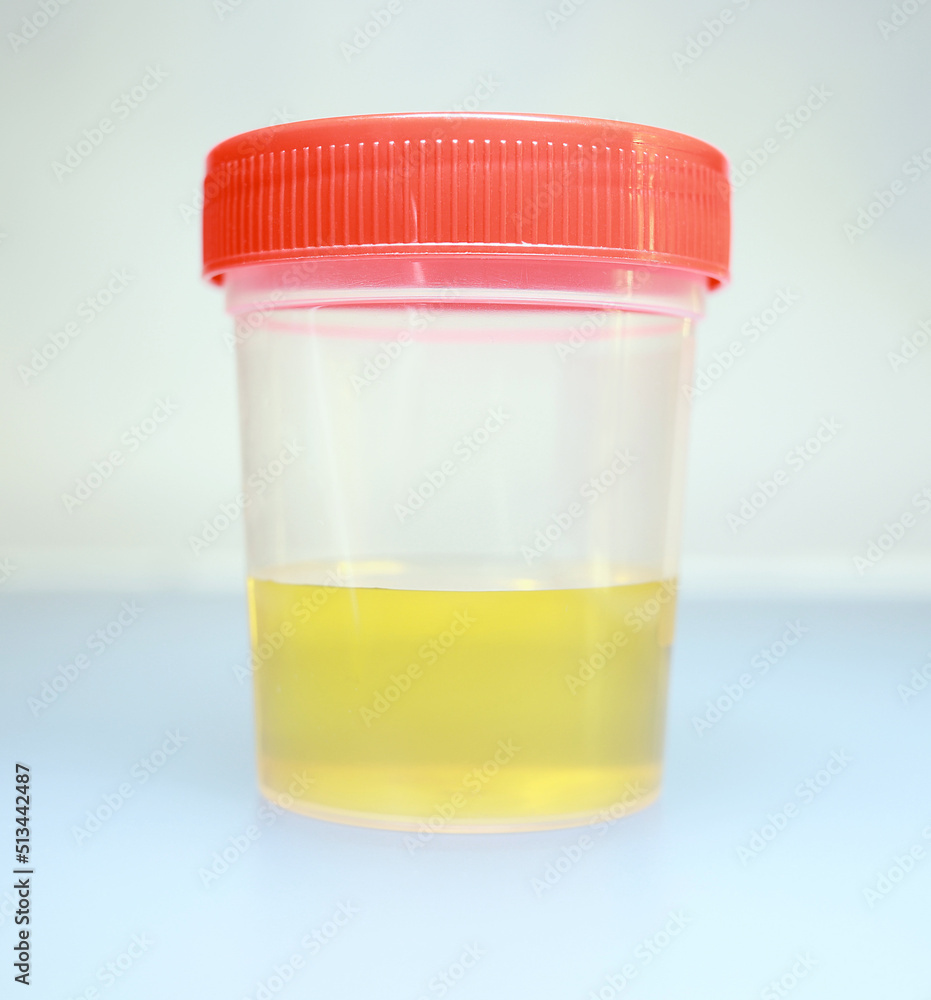 Urine sample in a biomaterial container. Medical urine test. Medical