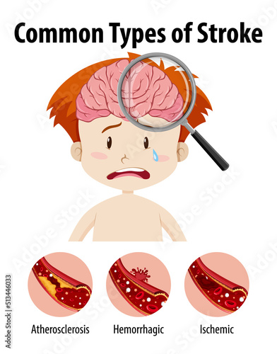 Human with common types of stroke