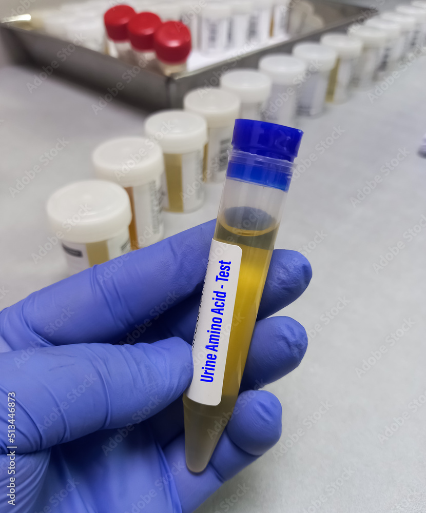 Foto Stock Container with urine sample for Urinary Amino Acid test, to