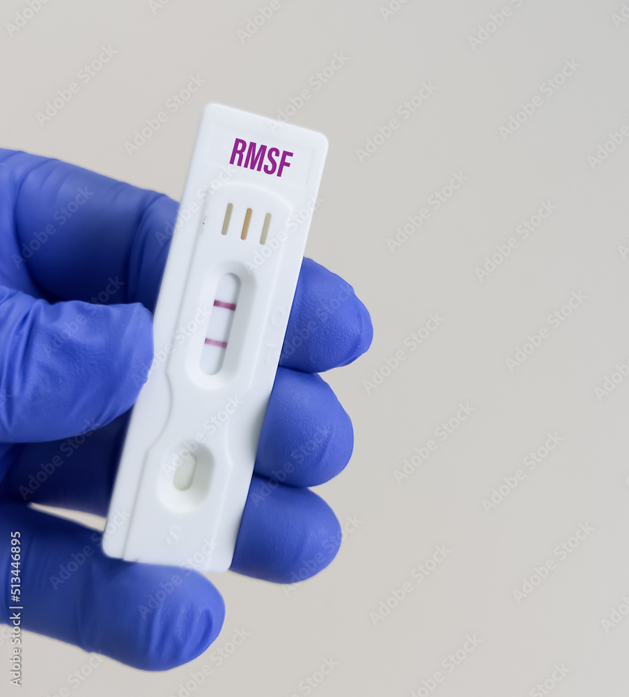 Holding a rapid test device for Rocky Mountain Spotted Fever(RMSF) test, show positive result. Holding a rapid test device for Rocky Mountain Spotted Fever(RMSF) test, show positive result.
