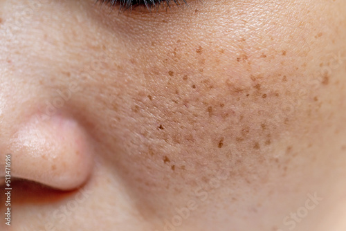 Woman's problematic skin pore and dark spots on the face photo