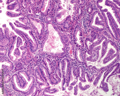 Human uterus. Endometroid carcinoma photo