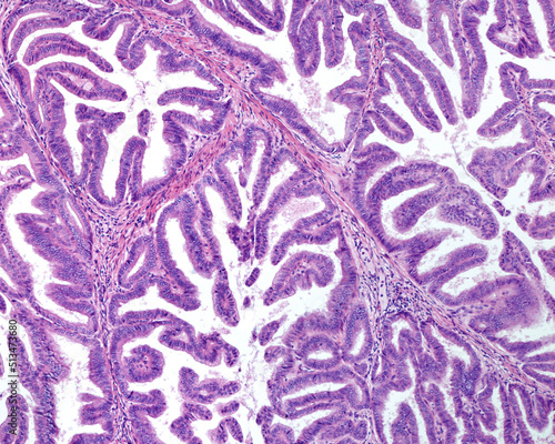 Human uterus. Endometroid carcinoma photo