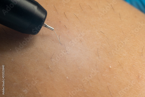 Process of permanent hair removal, removing unwanted hair using an electroepilation device, close-up macro