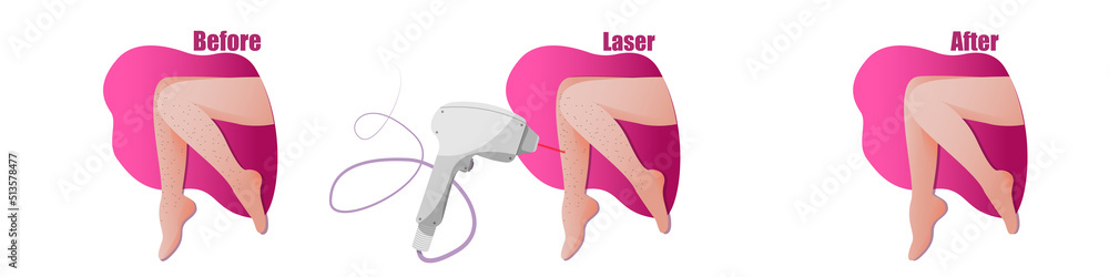 vector leg epilation banner, female legs, smooth skin, layout with the result of the procedure, hardware cosmetology - obrazy, fototapety, plakaty 