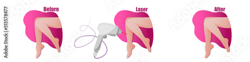 vector leg epilation banner, female legs, smooth skin, layout with the result of the procedure, hardware cosmetology