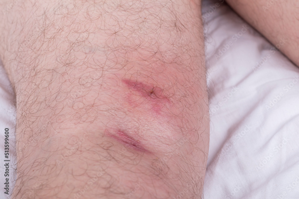 male legs with hair are lying on a white sheet. there are many small redness male legs with hair are lying on a white sheet. there are many small redness