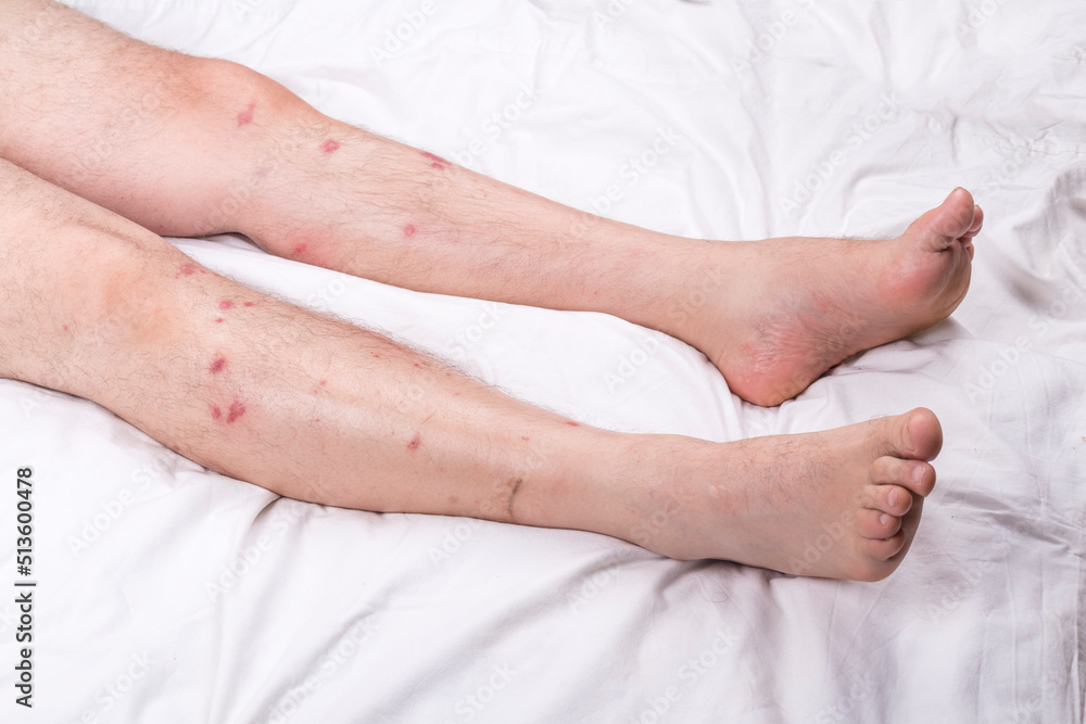 male legs with hair are lying on a white sheet. there are many small redness - obrazy, fototapety, plakaty 