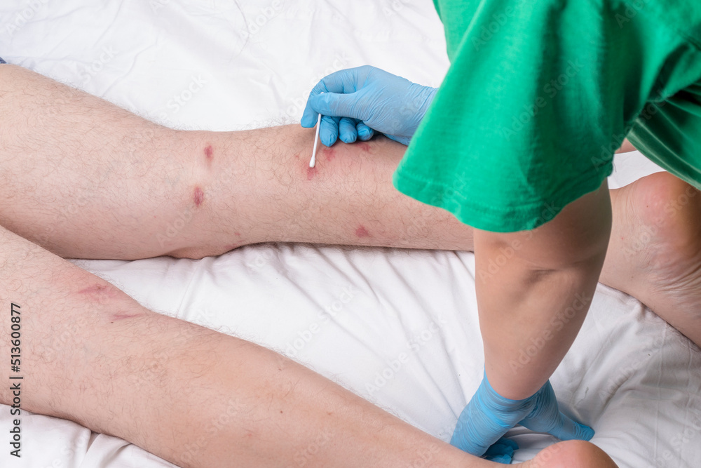 male legs with hair are lying on a white sheet. there are many small redness male legs with hair are lying on a white sheet. there are many small redness