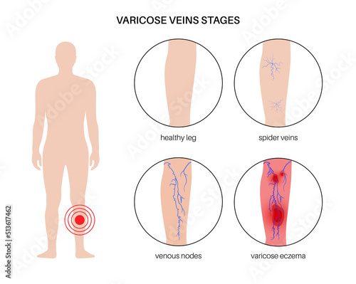 Varicose veins treatment
