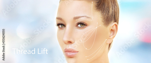 Thread Lift ,markup, thread-lift procedure for facial rejuvenation.