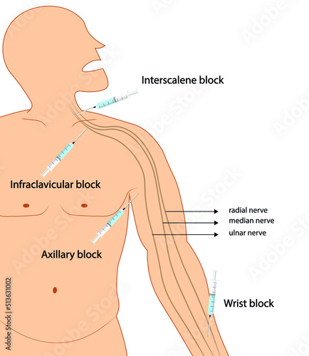 Upper extremity nerve block. Regional anesthesia ilustration. Needle placement. 