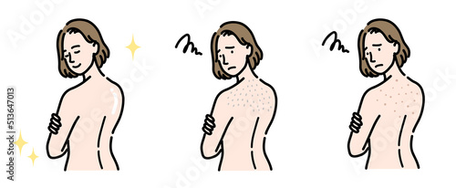 背中の肌トラブルに悩んでいる若い女性のセット
