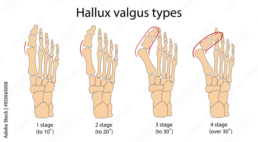 Hallux valgus medical infographic. Vector illustration. Stock Vector ...