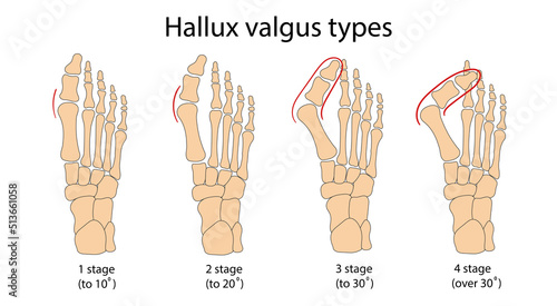 Hallux valgus medical infographic. Vector illustration.