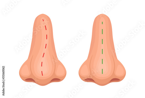 Crooked and correct nose. Nose before and after treatment. Vector illustration