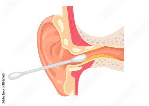 illustration of cleaning the ear canal with a cotton swab. Ear section with earwax. Incorrect use of a cotton swab.