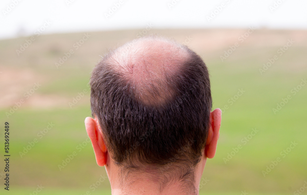 Bald head nape head baldness, hair transplant hair loss, stress Bald head nape head baldness, hair transplant hair loss, stress