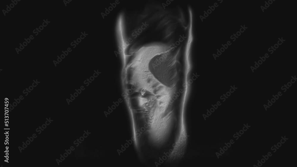 Voluminous CT scan of the abdomen. Computed tomography of the gastrointestinal tract, liver and kidneys Voluminous CT scan of the abdomen. Computed tomography of the gastrointestinal tract, liver and kidneys