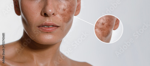 Hyperpigmentation of female skin, close-up of a part of the face on a white background, cosmetology, dermatology, skin care photo