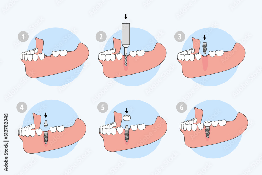 Dental implant procedure explained step by step