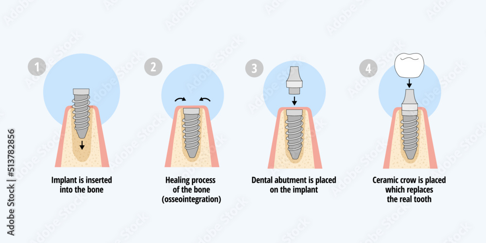 Fototapeta premium Single dental implant placement process