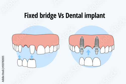 Thooth replacement whit a traditional bridge Vs dental implant