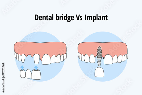 Thooth replacement whit a traditional bridge Vs dental implant