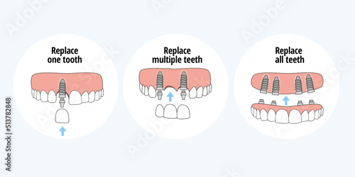 Types of dental implants to replace one tooth, multiple teeth and all teeth