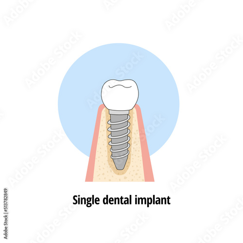 Solution to dental loss with a unitary dental implant and crown. Healthy teeth