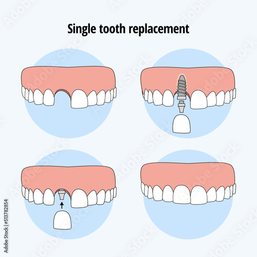 Single  tooth replacement. Dental Implant