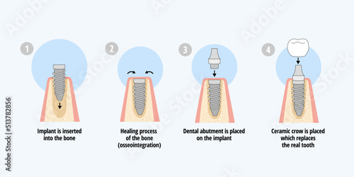 Single dental implant placement process