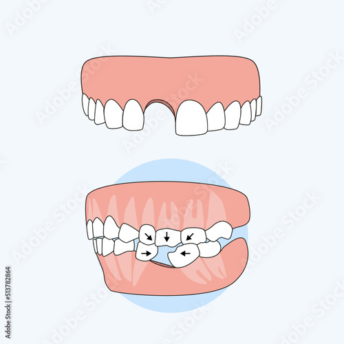 Consequence of not fixing the denture after tooth loss