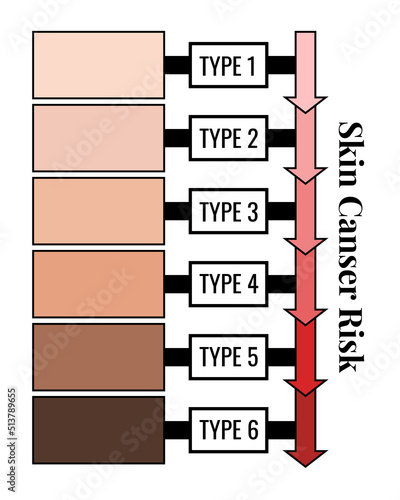 Fitzpatrick skin phototype scale with cancer risk dependence. Vertical infpgraphic chart type I II III IV V and IV skin and hair color flat design vector illustration.