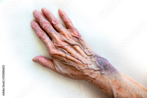 Obraz na płótnie the hand of an elderly woman with bruises w salonie