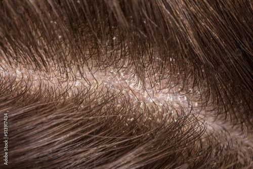 Dandruff seborrhea problem of scalp and hair treatment of peeling from allergies or lichen photo