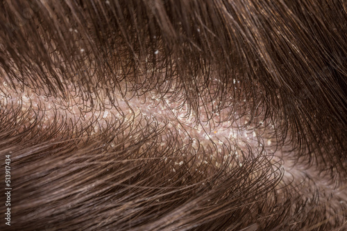 фотографія Dandruff seborrhea problem of scalp and hair treatment of peeling from allergies