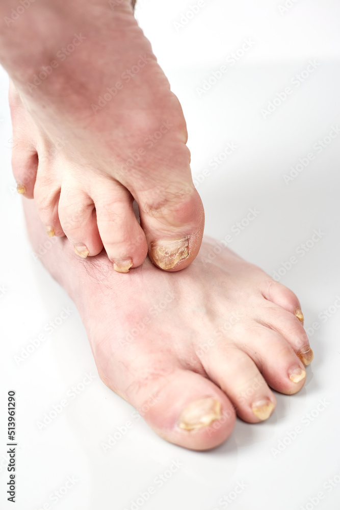 Nail fungus on legs disease. Fungal infection on nails legs, finger