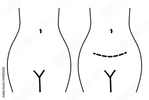 Gynecological surgery, problem with reproductive system. Thin line icon.