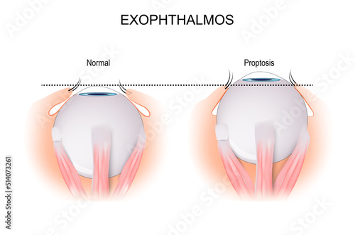 Exophthalmos. comparison and difference photo