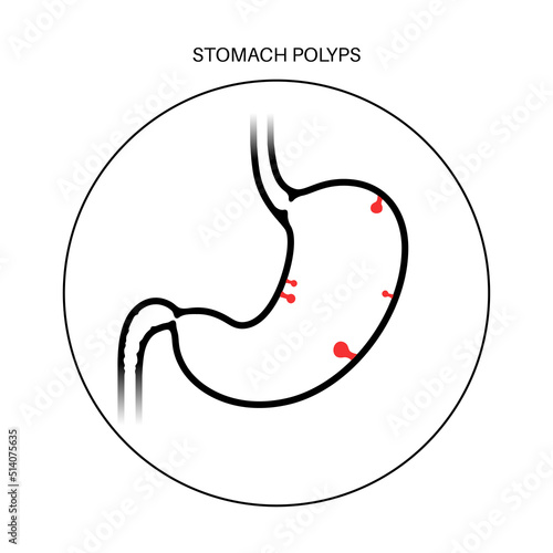 Stomach polyp disease
