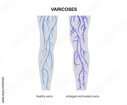 Varicose veins treatment